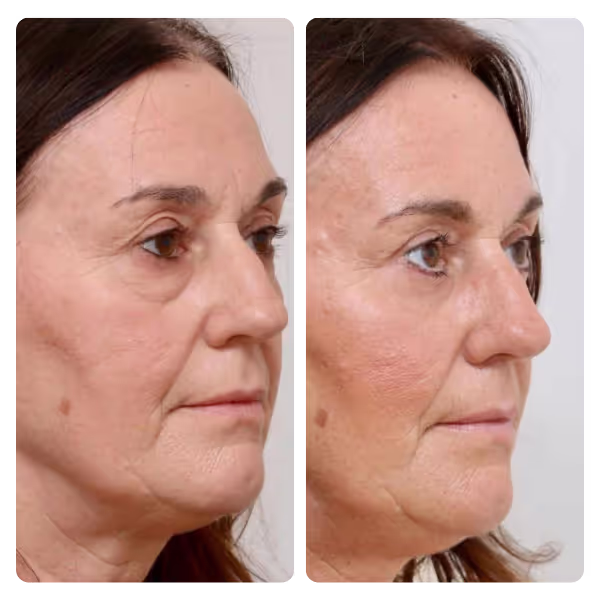 Eyelid Surgery (Blepharoplasty) in Turkey